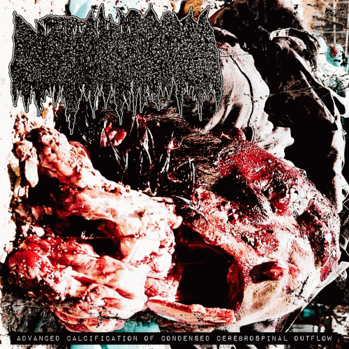 Cystic Hygroma : Advanced Calcification of Condensed Cerebrospinal Outflow